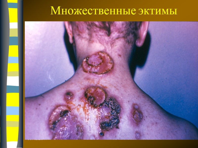 09.12.2017 Множественные эктимы